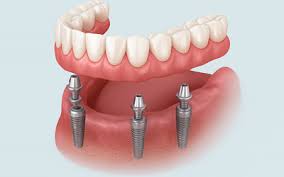 dental-implants-in-the-dominican-republic-and-cost:-affordable-‎smiles-abroad
